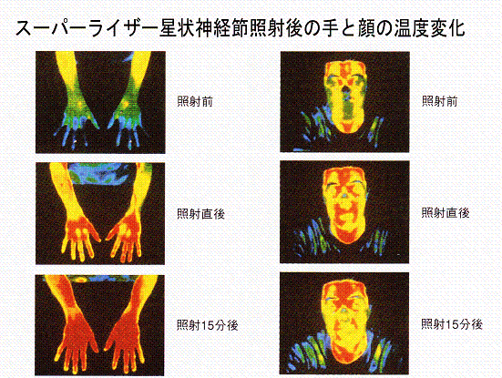 星状神経節照射後の手・顔の温度変化